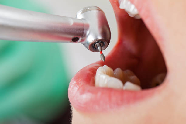 Best Knocked-Out Tooth (Avulsed Tooth) Treatment in Granite Hills, CA